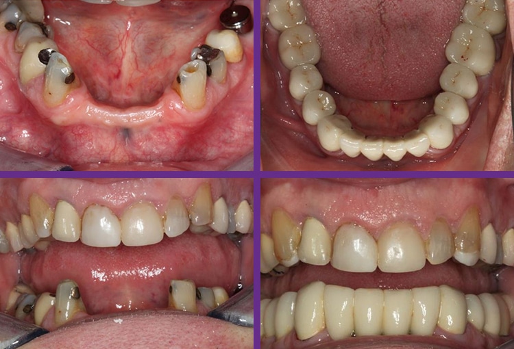 dental-implant-testimonial
