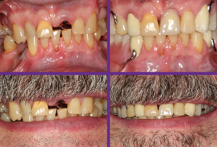 dental-implant-testimonial