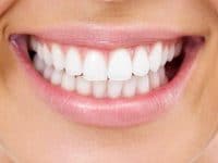 Tewksbury Teeth Whitening: What Type Is Best for You?