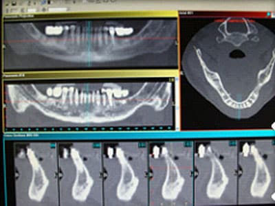 Virtual Implant Placement Software
